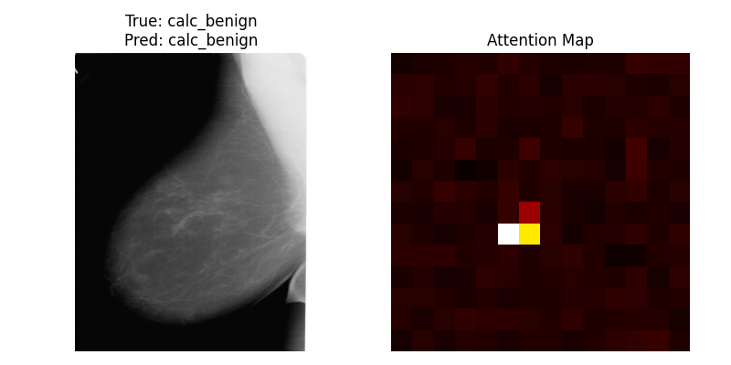 Mammogram prediction with its Vision Transformer attention map